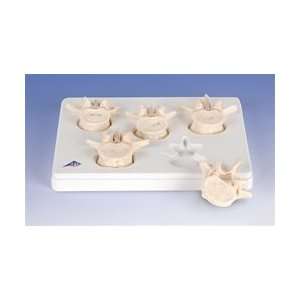  Set of 5 Lumbar Vertebrae