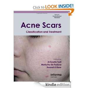 Acne Scars Classification and Treatment (Series in Dermatological 