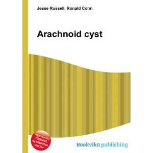  Arachnoid cyst Ronald Cohn Jesse Russell Books