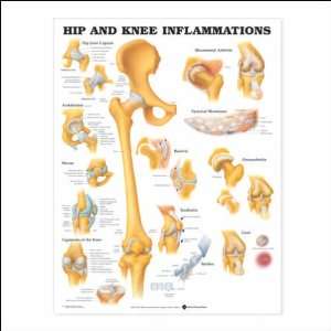  Hip and Knee Inflammations Anatomical Chart 20 X 26 